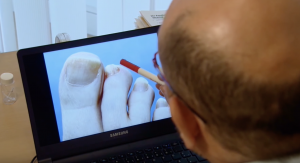 Nagelpilz-Behandlung Video