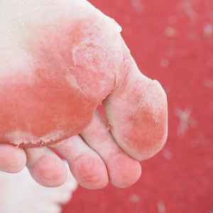Pilzerreger: Häufig greift Fußpilz auch auf die Nägel über
